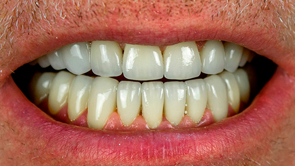 Диоксид Циркония На Передние Зубы Фото