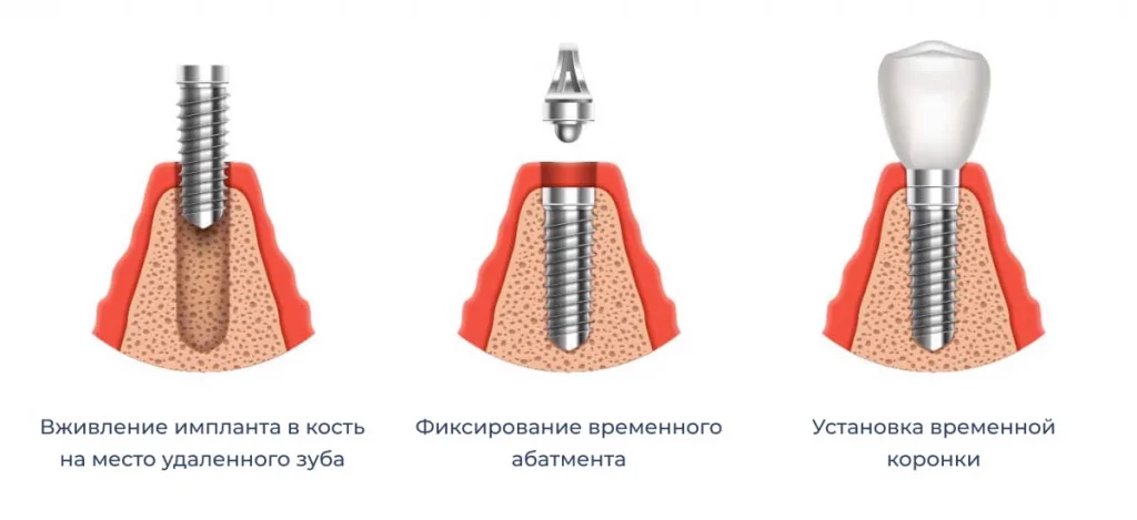Схема в три шага: установка импланта, временный абатмент, временная коронка